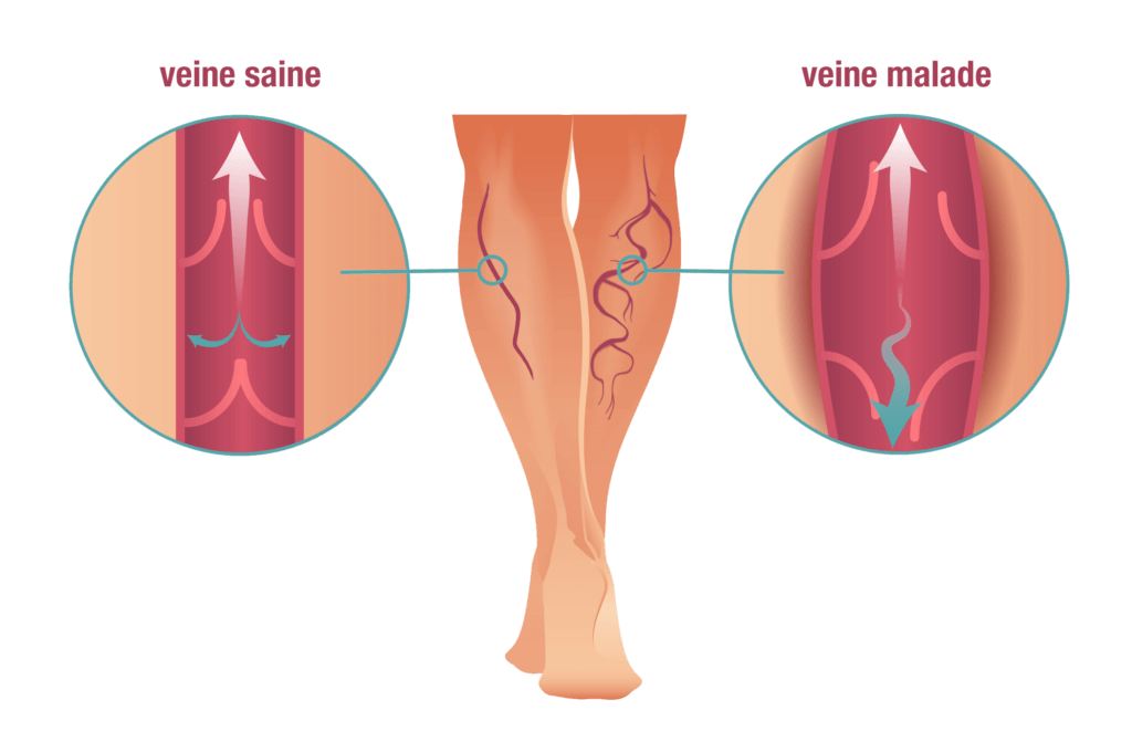 Bas de varices flamants roses confort et compression contrôlée à la jambe  FShip